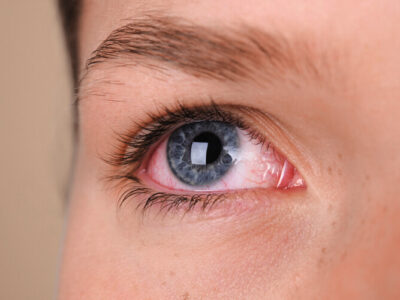 Olhos vermelhos constantemente podem indicar problemas na visão?
